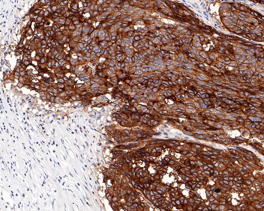 Immunohistochemistry: CD47 Antibody (PD00-33) [NBP3-32156] - Immunohistochemical analysis of paraffin-embedded human ovarian tumor tissue with Rabbit anti-CD47 antibody (NBP3-32156) at 1/1,000 dilution. The section was pre-treated using heat mediated antigen retrieval with Tris-EDTA buffer (pH 9.0) for 20 minutes. The tissues were blocked in 1% BSA for 20 minutes at room temperature, washed with ddH2O and PBS, and then probed with the primary antibody (NBP3-32156) at 1/1,000 dilution for 1 hour at room temperature. The detection was performed using an HRP conjugated compact polymer system. DAB was used as the chromogen. Tissues were counterstained with hematoxylin and mounted with DPX.