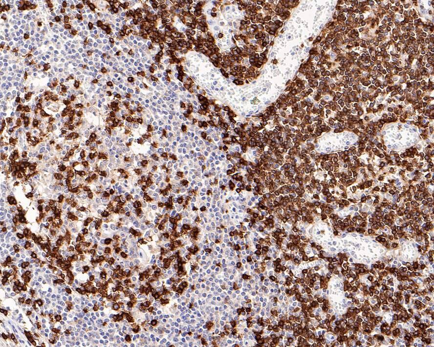 Immunohistochemistry: CD5 Antibody (PD00-01) [NBP3-32158] - Immunohistochemical analysis of paraffin-embedded human lymph nodes tissue with Rabbit anti-CD5 antibody (NBP3-32158) at 1/1,500 dilution. The section was pre-treated using heat mediated antigen retrieval with Tris-EDTA buffer (pH 9.0) for 20 minutes. The tissues were blocked in 1% BSA for 20 minutes at room temperature, washed with ddH2O and PBS, and then probed with the primary antibody (NBP3-32158) at 1/1,500 dilution for 1 hour at room temperature. The detection was performed using an HRP conjugated compact polymer system. DAB was used as the chromogen. Tissues were counterstained with hematoxylin and mounted with DPX.