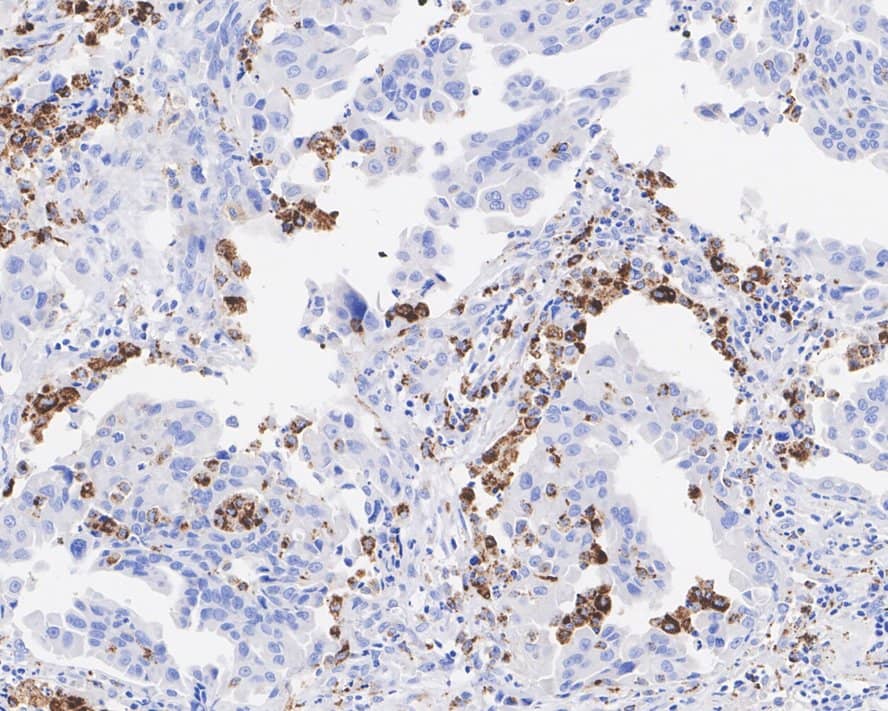 Immunohistochemistry: CD68/SR-D1 Antibody (A3C3-R) [NBP3-32163] - Immunohistochemical analysis of paraffin-embedded human lung cancer tissue with Mouse anti-CD68/SR-D1 antibody (NBP3-32163) at 1/1,000 dilution. The section was pre-treated using heat mediated antigen retrieval with Tris-EDTA buffer (pH 9.0) for 20 minutes. The tissues were blocked in 1% BSA for 20 minutes at room temperature, washed with ddH2O and PBS, and then probed with the primary antibody (NBP3-32163) at 1/1,000 dilution for 1 hour at room temperature. The detection was performed using an HRP conjugated compact polymer system. DAB was used as the chromogen. Tissues were counterstained with hematoxylin and mounted with DPX.