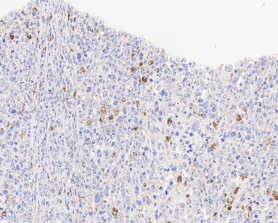 Immunohistochemistry: CD68/SR-D1 Antibody (A3C2-R) [NBP3-32164] - Immunohistochemical analysis of paraffin-embedded human prostate cancer tissue with Mouse anti-CD68/SR-D1 antibody (NBP3-32164) at 1/1,000 dilution. The section was pre-treated using heat mediated antigen retrieval with Tris-EDTA buffer (pH 9.0) for 20 minutes. The tissues were blocked in 1% BSA for 20 minutes at room temperature, washed with ddH2O and PBS, and then probed with the primary antibody (NBP3-32164) at 1/1,000 dilution for 1 hour at room temperature. The detection was performed using an HRP conjugated compact polymer system. DAB was used as the chromogen. Tissues were counterstained with hematoxylin and mounted with DPX.