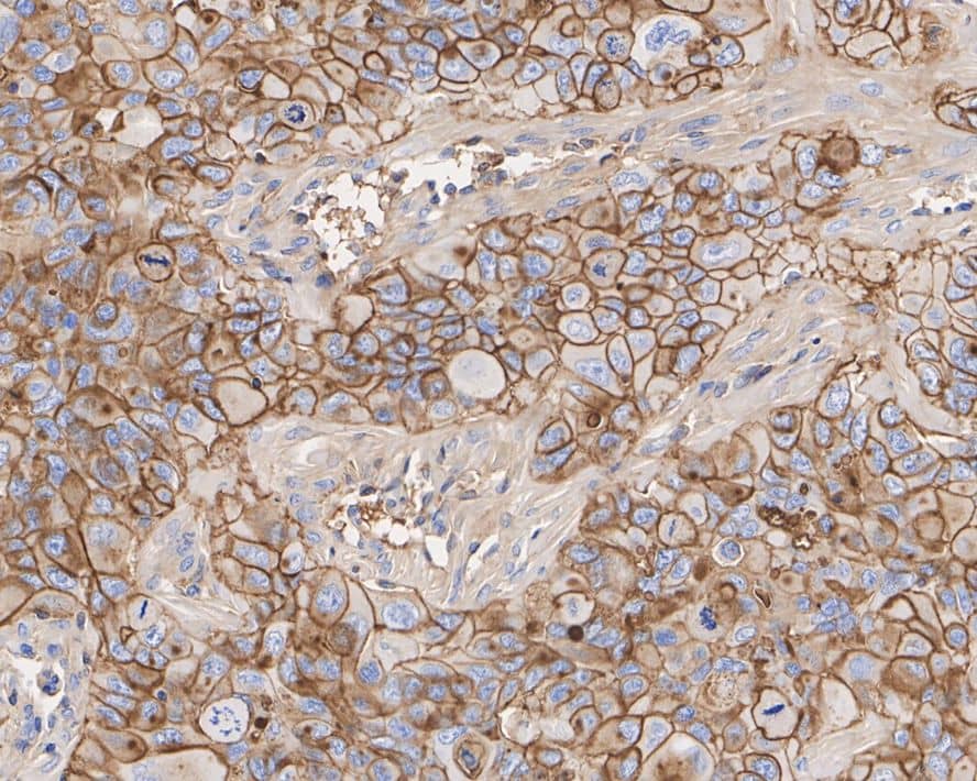 Immunohistochemistry: 5'-Nucleotidase/CD73 Antibody (A6G2-R) [NBP3-32166] - Immunohistochemical analysis of paraffin-embedded NCI-H441 xenograft tissue with Mouse anti-5'-Nucleotidase/CD73 antibody (NBP3-32166) at 1/1,000 dilution. The section was pre-treated using heat mediated antigen retrieval with Tris-EDTA buffer (pH 9.0) for 20 minutes. The tissues were blocked in 1% BSA for 20 minutes at room temperature, washed with ddH2O and PBS, and then probed with the primary antibody (NBP3-32166) at 1/1,000 dilution for 1 hour at room temperature. The detection was performed using an HRP conjugated compact polymer system. DAB was used as the chromogen. Tissues were counterstained with hematoxylin and mounted with DPX.
