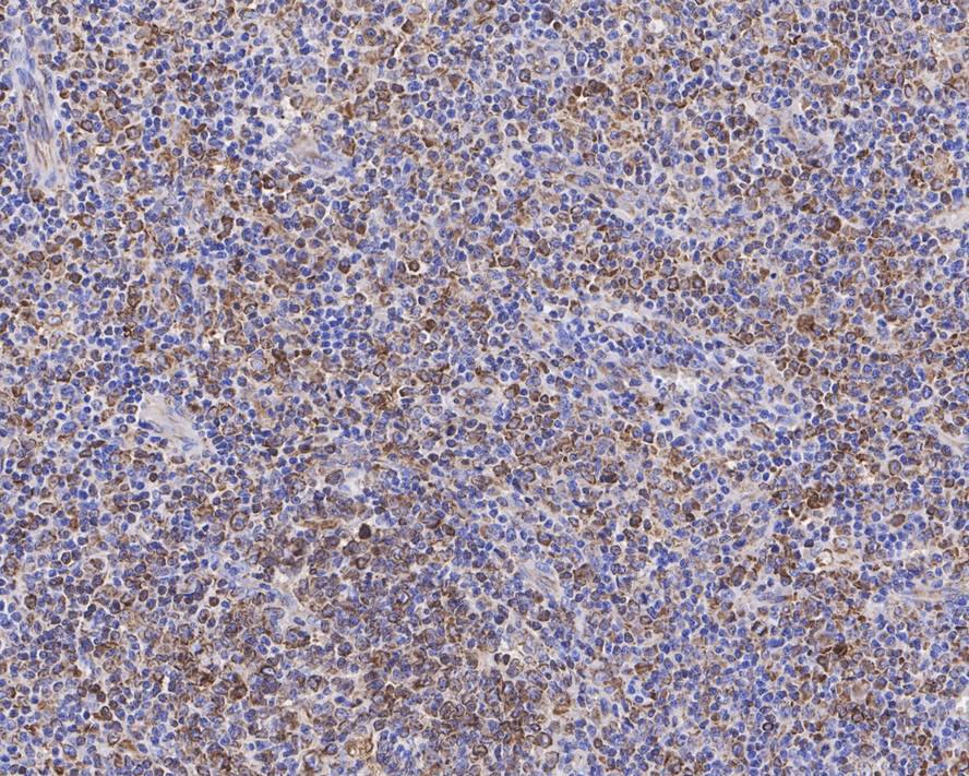Immunohistochemistry: CD74 Antibody (PDM0-22) [NBP3-32167] - Immunohistochemical analysis of paraffin-embedded human B-cell lymphoma tissue with Mouse anti-CD74 antibody (NBP3-32167) at 1/5,000 dilution. The section was pre-treated using heat mediated antigen retrieval with Tris-EDTA buffer (pH 9.0) for 20 minutes. The tissues were blocked in 1% BSA for 20 minutes at room temperature, washed with ddH2O and PBS, and then probed with the primary antibody (NBP3-32167) at 1/5,000 dilution for 1 hour at room temperature. The detection was performed using an HRP conjugated compact polymer system. DAB was used as the chromogen. Tissues were counterstained with hematoxylin and mounted with DPX.