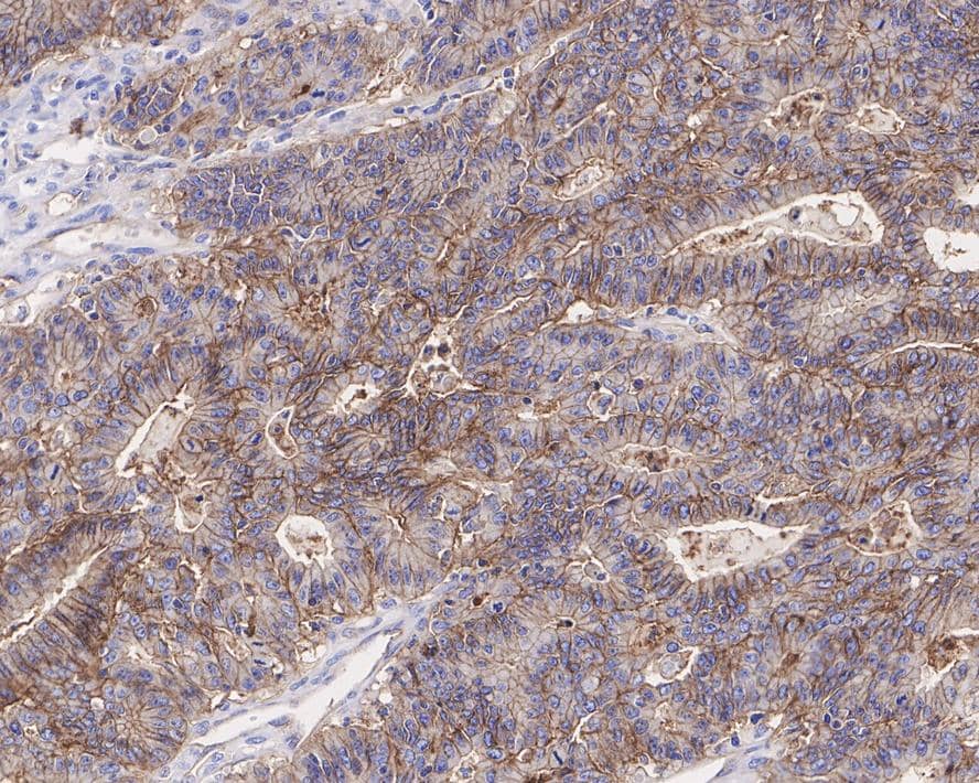 Immunohistochemistry: CD9 Antibody (PSH0-95) [NBP3-32171] - Immunohistochemical analysis of paraffin-embedded human colon carcinoma tissue with Rabbit anti-CD9 antibody (NBP3-32171) at 1/1,000 dilution. The section was pre-treated using heat mediated antigen retrieval with Tris-EDTA buffer (pH 9.0) for 20 minutes. The tissues were blocked in 1% BSA for 20 minutes at room temperature, washed with ddH2O and PBS, and then probed with the primary antibody (NBP3-32171) at 1/1,000 dilution for 1 hour at room temperature. The detection was performed using an HRP conjugated compact polymer system. DAB was used as the chromogen. Tissues were counterstained with hematoxylin and mounted with DPX.