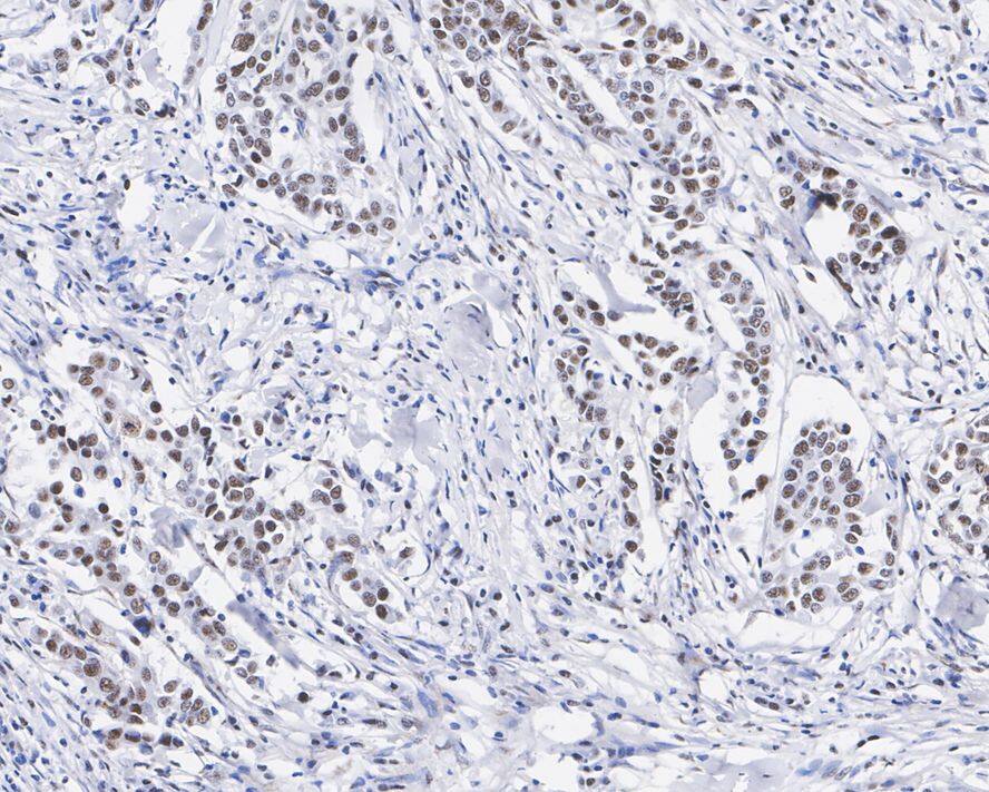 Immunohistochemistry: CDC25C Antibody (JE59-53) [NBP3-32173] - Immunohistochemical analysis of paraffin-embedded human breast cancer tissue with Rabbit anti-CDC25C antibody (NBP3-32173) at 1/2,000 dilution. The section was pre-treated using heat mediated antigen retrieval with sodium citrate buffer (pH 6.0) for 2 minutes. The tissues were blocked in 1% BSA for 20 minutes at room temperature, washed with ddH2O and PBS, and then probed with the primary antibody (NBP3-32173) at 1/2,000 dilution for 1 hour at room temperature. The detection was performed using an HRP conjugated compact polymer system. DAB was used as the chromogen. Tissues were counterstained with hematoxylin and mounted with DPX.