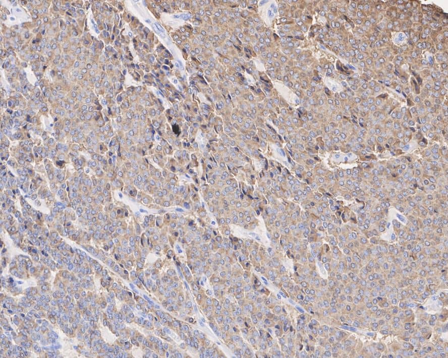 Immunohistochemistry: Chromogranin A Antibody (D11-2-R) [NBP3-32185] - Immunohistochemical analysis of paraffin-embedded human atypical carcinoid tissue with Mouse anti-Chromogranin A antibody (NBP3-32185) at 1/15,000 dilution. The section was pre-treated using heat mediated antigen retrieval with Tris-EDTA buffer (pH 9.0) for 20 minutes. The tissues were blocked in 1% BSA for 20 minutes at room temperature, washed with ddH2O and PBS, and then probed with the primary antibody (NBP3-32185) at 1/15,000 dilution for 1 hour at room temperature. The detection was performed using an HRP conjugated compact polymer system. DAB was used as the chromogen. Tissues were counterstained with hematoxylin and mounted with DPX.