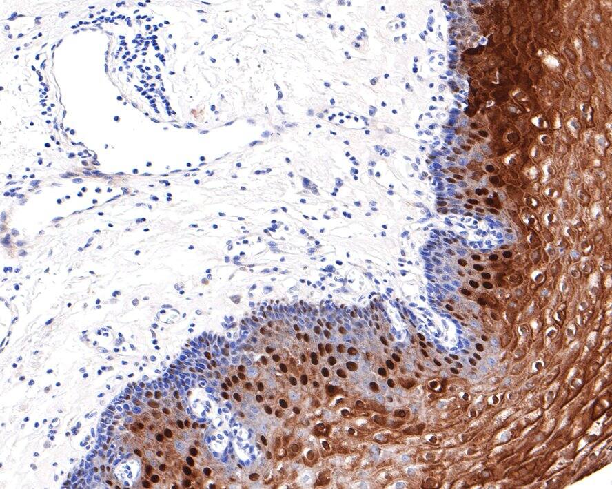 Immunohistochemistry: CRABP2 Antibody (JE65-66) [NBP3-32214] - Immunohistochemical analysis of paraffin-embedded human esophagus tissue with Rabbit anti-CRABP2 antibody (NBP3-32214) at 1/400 dilution. The section was pre-treated using heat mediated antigen retrieval with Tris-EDTA buffer (pH 9.0) for 20 minutes. The tissues were blocked in 1% BSA for 20 minutes at room temperature, washed with ddH2O and PBS, and then probed with the primary antibody (NBP3-32214) at 1/400 dilution for 1 hour at room temperature. The detection was performed using an HRP conjugated compact polymer system. DAB was used as the chromogen. Tissues were counterstained with hematoxylin and mounted with DPX.