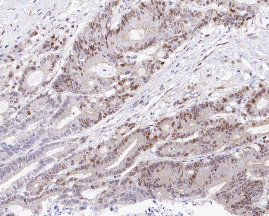 Immunohistochemistry: Cyclin D1 Antibody (PD01-64) [NBP3-32236] - Immunohistochemical analysis of paraffin-embedded human colon carcinoma tissue with Rabbit anti-Cyclin D1 antibody (NBP3-32236) at 1/200 dilution. The section was pre-treated using heat mediated antigen retrieval with sodium citrate buffer (pH 6.0) for 2 minutes. The tissues were blocked in 1% BSA for 20 minutes at room temperature, washed with ddH2O and PBS, and then probed with the primary antibody (NBP3-32236) at 1/200 dilution for 1 hour at room temperature. The detection was performed using an HRP conjugated compact polymer system. DAB was used as the chromogen. Tissues were counterstained with hematoxylin and mounted with DPX.