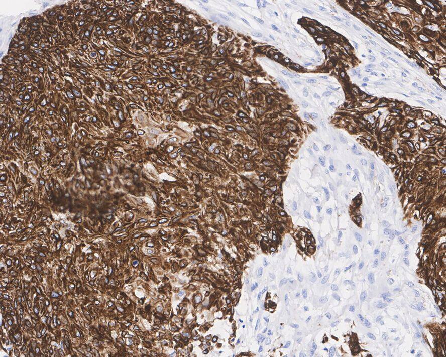Immunohistochemistry: Cytokeratin 17 Antibody (A2B10-R) [NBP3-32244] - Immunohistochemical analysis of paraffin-embedded human cervical cancer tissue with Mouse anti-Cytokeratin 17 antibody (NBP3-32244) at 1/1,000 dilution. The section was pre-treated using heat mediated antigen retrieval with Tris-EDTA buffer (pH 9.0) for 20 minutes. The tissues were blocked in 1% BSA for 20 minutes at room temperature, washed with ddH2O and PBS, and then probed with the primary antibody (NBP3-32244) at 1/1,000 dilution for 1 hour at room temperature. The detection was performed using an HRP conjugated compact polymer system. DAB was used as the chromogen. Tissues were counterstained with hematoxylin and mounted with DPX.