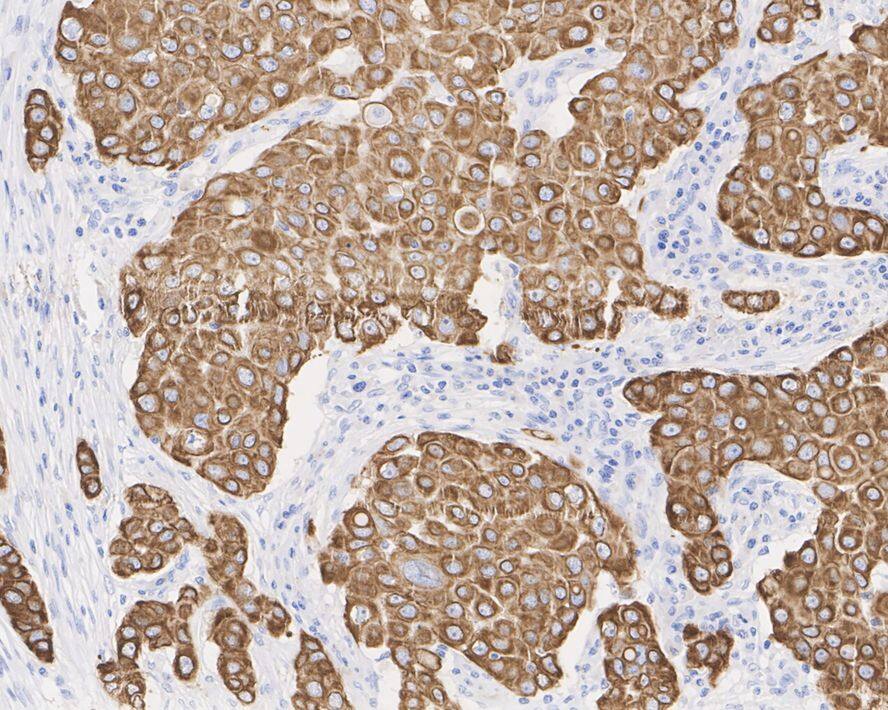 Immunohistochemistry: Cytokeratin 18 Antibody (6-19-R) [NBP3-32246] - Immunohistochemical analysis of paraffin-embedded human breast cancer tissue with Mouse anti-Cytokeratin 18 antibody (NBP3-32246) at 1/2,000 dilution. The section was pre-treated using heat mediated antigen retrieval with Tris-EDTA buffer (pH 9.0) for 20 minutes. The tissues were blocked in 1% BSA for 20 minutes at room temperature, washed with ddH2O and PBS, and then probed with the primary antibody (NBP3-32246) at 1/2,000 dilution for 1 hour at room temperature. The detection was performed using an HRP conjugated compact polymer system. DAB was used as the chromogen. Tissues were counterstained with hematoxylin and mounted with DPX.
