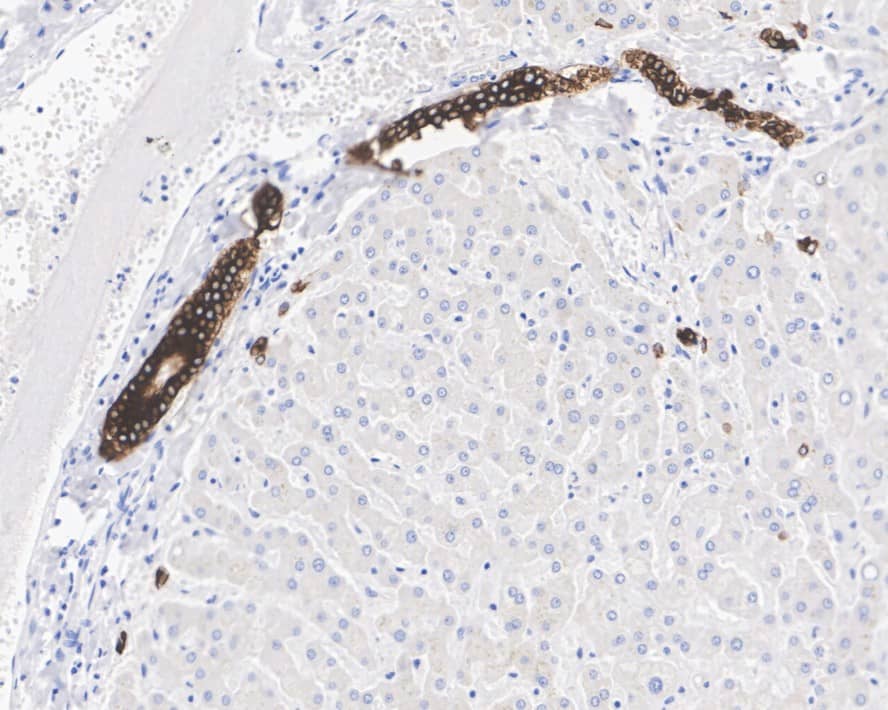 Immunohistochemistry: Cytokeratin 19 Antibody (A3D1-R) [NBP3-32247] - Immunohistochemical analysis of paraffin-embedded human liver tissue with Mouse anti-Cytokeratin 19 antibody (NBP3-32247) at 1/1,000 dilution. The section was pre-treated using heat mediated antigen retrieval with Tris-EDTA buffer (pH 9.0) for 20 minutes. The tissues were blocked in 1% BSA for 20 minutes at room temperature, washed with ddH2O and PBS, and then probed with the primary antibody (NBP3-32247) at 1/1,000 dilution for 1 hour at room temperature. The detection was performed using an HRP conjugated compact polymer system. DAB was used as the chromogen. Tissues were counterstained with hematoxylin and mounted with DPX.