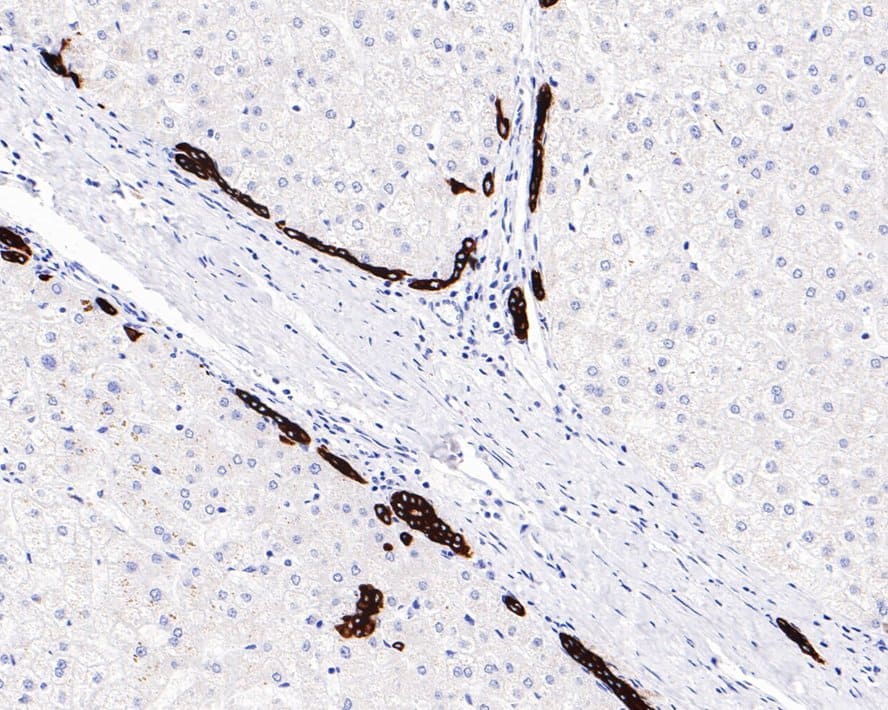 Immunohistochemistry: Cytokeratin 19 Antibody (SA30-06) [NBP3-32248] - Immunohistochemical analysis of paraffin-embedded human liver tissue with Rabbit anti-Cytokeratin 19 antibody (NBP3-32248) at 1/1,000 dilution. The section was pre-treated using heat mediated antigen retrieval with Tris-EDTA buffer (pH 9.0) for 20 minutes. The tissues were blocked in 1% BSA for 20 minutes at room temperature, washed with ddH2O and PBS, and then probed with the primary antibody (NBP3-32248) at 1/1,000 dilution for 1 hour at room temperature. The detection was performed using an HRP conjugated compact polymer system. DAB was used as the chromogen. Tissues were counterstained with hematoxylin and mounted with DPX.