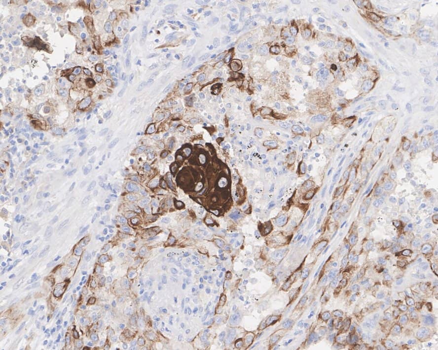 Immunohistochemistry: Cytokeratin 5/6 Antibody (A2B2-R) [NBP3-32250] - Immunohistochemical analysis of paraffin-embedded human lung adenocarcinoma tissue with Mouse anti-Cytokeratin 5/6 antibody (NBP3-32250) at 1/200 dilution. The section was pre-treated using heat mediated antigen retrieval with Tris-EDTA buffer (pH 9.0) for 20 minutes. The tissues were blocked in 1% BSA for 20 minutes at room temperature, washed with ddH2O and PBS, and then probed with the primary antibody (NBP3-32250) at 1/200 dilution for 1 hour at room temperature. The detection was performed using an HRP conjugated compact polymer system. DAB was used as the chromogen. Tissues were counterstained with hematoxylin and mounted with DPX.