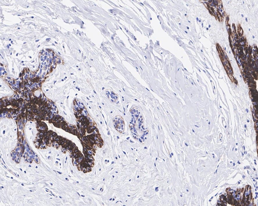 Immunohistochemistry: Cytokeratin 5/6 Antibody (PSH0-67) [NBP3-32251] - Immunohistochemical analysis of paraffin-embedded human breast tissue with Rabbit anti-Cytokeratin 5/6 antibody (NBP3-32251) at 1/1,000 dilution. The section was pre-treated using heat mediated antigen retrieval with Tris-EDTA buffer (pH 9.0) for 20 minutes. The tissues were blocked in 1% BSA for 20 minutes at room temperature, washed with ddH2O and PBS, and then probed with the primary antibody (NBP3-32251) at 1/1,000 dilution for 1 hour at room temperature. The detection was performed using an HRP conjugated compact polymer system. DAB was used as the chromogen. Tissues were counterstained with hematoxylin and mounted with DPX.