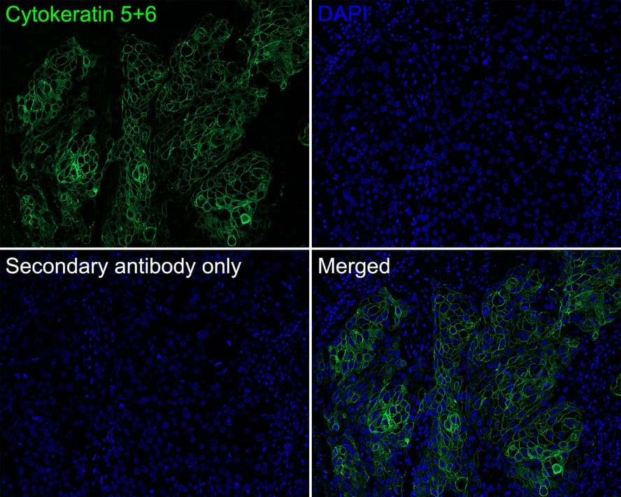 Immunohistochemistry: Cytokeratin 5/6 Antibody (PSH0-67) [NBP3-32251] - Immunofluorescence analysis of paraffin-embedded human lung squamous cell carcinoma tissue labeling Cytokeratin 5/6 with Rabbit anti-Cytokeratin 5/6 antibody (NBP3-32251) at 1/1,000 dilution. The section was pre-treated using heat mediated antigen retrieval with Tris-EDTA buffer (pH 9.0) for 20 minutes. The tissues were blocked in 10% negative goat serum for 1 hour at room temperature, washed with PBS, and then probed with the primary antibody (NBP3-32251, green) at 1/1,000 dilution overnight at 4 ℃, washed with PBS. Goat Anti-Rabbit IgG H&L (iFluor™ 488) was used as the secondary antibody at 1/1,000 dilution. Nuclei were counterstained with DAPI (blue).