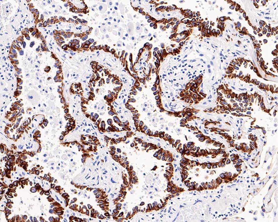 Immunohistochemistry: Cytokeratin 7 Antibody (3-G3-D8-R) [NBP3-32253] - Immunohistochemical analysis of paraffin-embedded human lung carcinoma tissue with Mouse anti-Cytokeratin 7 antibody (NBP3-32253) at 1/200 dilution. The section was pre-treated using heat mediated antigen retrieval with Tris-EDTA buffer (pH 9.0) for 20 minutes. The tissues were blocked in 1% BSA for 20 minutes at room temperature, washed with ddH2O and PBS, and then probed with the primary antibody (NBP3-32253) at 1/200 dilution for 1 hour at room temperature. The detection was performed using an HRP conjugated compact polymer system. DAB was used as the chromogen. Tissues were counterstained with hematoxylin and mounted with DPX.