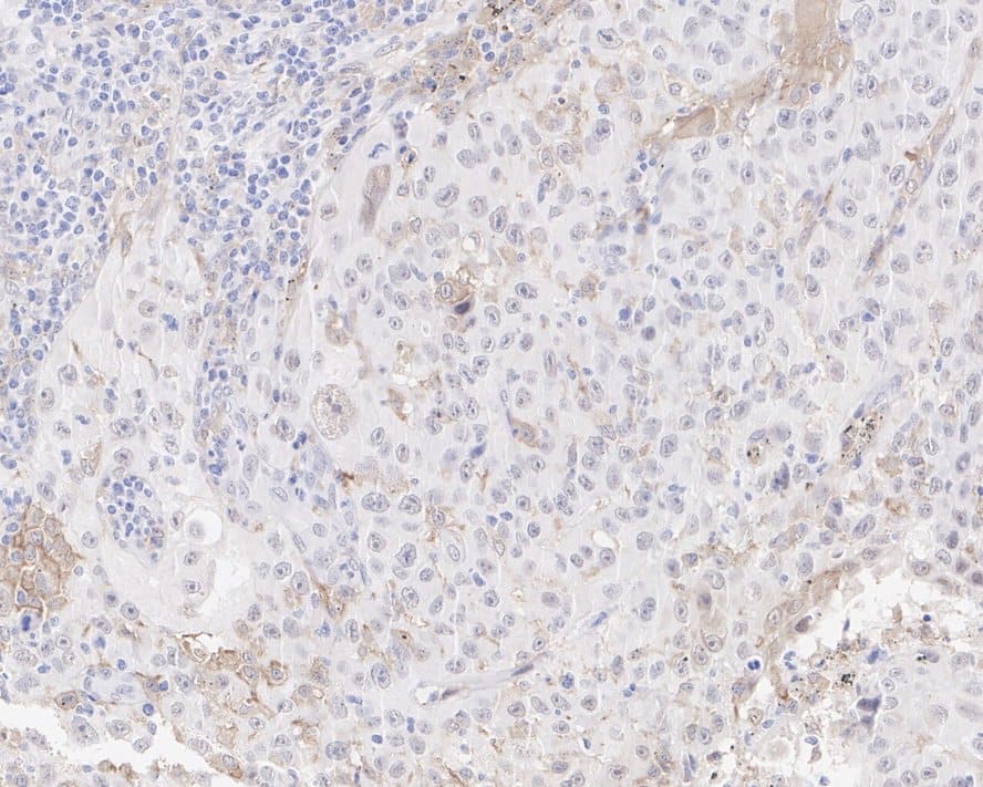 Immunohistochemistry: DAP Kinase 1 Antibody (12B2-R) [NBP3-32256] - Immunohistochemical analysis of paraffin-embedded human lung carcinoma tissue with Rabbit anti-DAP Kinase 1 antibody (NBP3-32256) at 1/2,000 dilution. The section was pre-treated using heat mediated antigen retrieval with Tris-EDTA buffer (pH 9.0) for 20 minutes. The tissues were blocked in 1% BSA for 20 minutes at room temperature, washed with ddH2O and PBS, and then probed with the primary antibody (NBP3-32256) at 1/2,000 dilution for 1 hour at room temperature. The detection was performed using an HRP conjugated compact polymer system. DAB was used as the chromogen. Tissues were counterstained with hematoxylin and mounted with DPX.