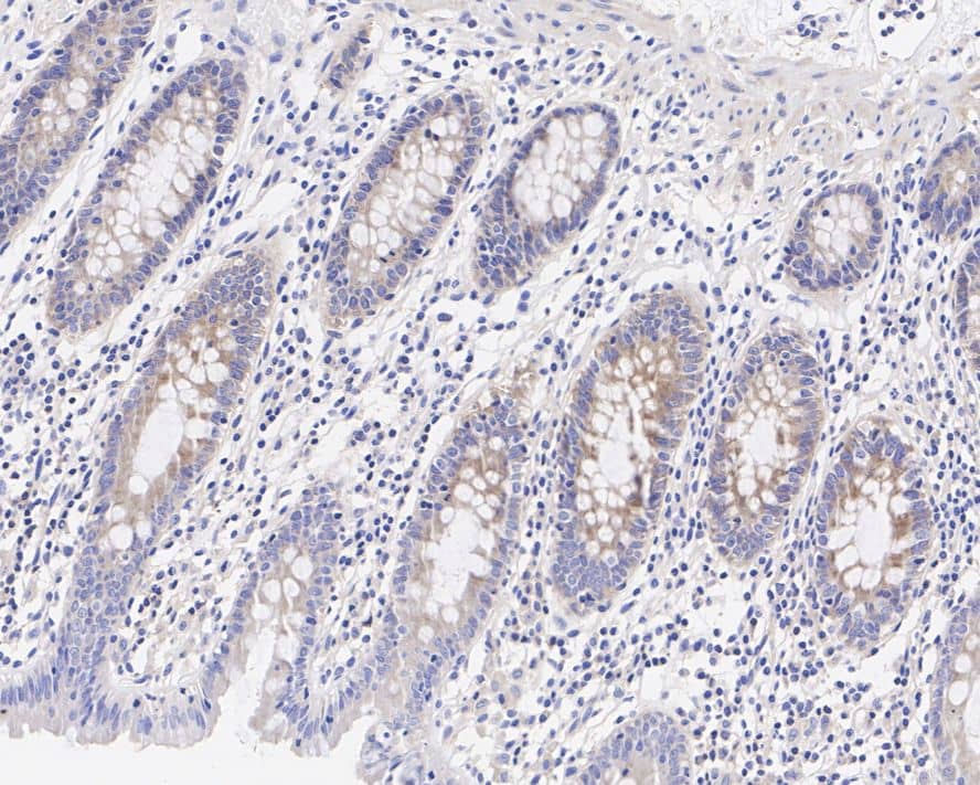 Immunohistochemistry: Dishevelled-2 Antibody (PSH04-07) [NBP3-32269] - Immunohistochemical analysis of paraffin-embedded human colon tissue with Rabbit anti-Dishevelled-2 antibody (NBP3-32269) at 1/100 dilution. The section was pre-treated using heat mediated antigen retrieval with Tris-EDTA buffer (pH 9.0) for 20 minutes. The tissues were blocked in 1% BSA for 20 minutes at room temperature, washed with ddH2O and PBS, and then probed with the primary antibody (NBP3-32269) at 1/100 dilution for 1 hour at room temperature. The detection was performed using an HRP conjugated compact polymer system. DAB was used as the chromogen. Tissues were counterstained with hematoxylin and mounted with DPX.