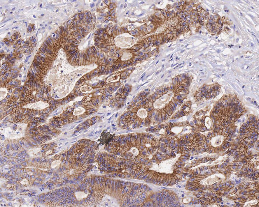 Immunohistochemistry: E-Cadherin Antibody (A0-G11-2-R) [NBP3-32289] - Immunohistochemical analysis of paraffin-embedded human breast carcinoma tissue with Mouse anti-E-Cadherin antibody (NBP3-32289) at 1,000 dilution. The section was pre-treated using heat mediated antigen retrieval with sodium citrate buffer (pH 6.0) for 2 minutes. The tissues were blocked in 1% BSA for 20 minutes at room temperature, washed with ddH2O and PBS, and then probed with the primary antibody (NBP3-32289) at 1/400 dilution for 1 hour at room temperature. The detection was performed using an HRP conjugated compact polymer system. DAB was used as the chromogen. Tissues were counterstained with hematoxylin and mounted with DPX.