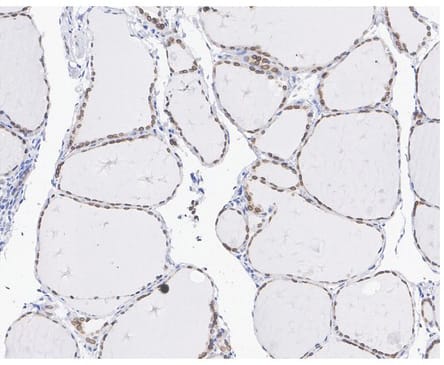 Immunohistochemistry: Emerin Antibody (PSH01-86) [NBP3-32308] - Immunohistochemical analysis of paraffin-embedded human thyroid tissue with Rabbit anti-Emerin antibody (NBP3-32308) at 1/1,000 dilution. The section was pre-treated using heat mediated antigen retrieval with sodium citrate buffer (pH 6.0) for 2 minutes. The tissues were blocked in 1% BSA for 20 minutes at room temperature, washed with ddH2O and PBS, and then probed with the primary antibody at 1/1,000 dilution for 1 hour at room temperature. The detection was performed using an HRP conjugated compact polymer system. DAB was used as the chromogen. Tissues were counterstained with hematoxylin and mounted with DPX.