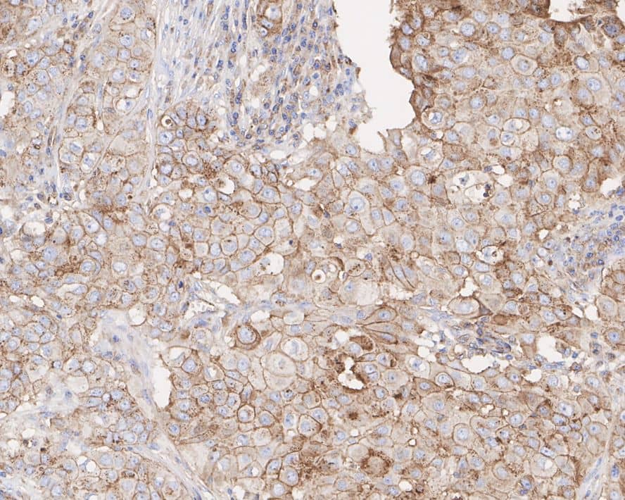 Immunohistochemistry: Flotillin 2 Antibody (PSH03-41) [NBP3-32343] - Immunohistochemical analysis of paraffin-embedded human breast cancer tissue with Rabbit anti-Flotillin 2 antibody (NBP3-32343) at 1/2,000 dilution. The section was pre-treated using heat mediated antigen retrieval with Tris-EDTA buffer (pH 9.0) for 20 minutes. The tissues were blocked in 1% BSA for 20 minutes at room temperature, washed with ddH2O and PBS, and then probed with the primary antibody (NBP3-32343) at 1/2,000 dilution for 1 hour at room temperature. The detection was performed using an HRP conjugated compact polymer system. DAB was used as the chromogen. Tissues were counterstained with hematoxylin and mounted with DPX.