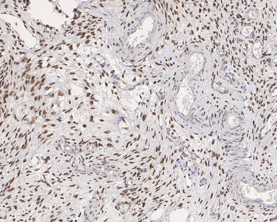 Immunohistochemistry: FOXL2 Antibody (JE38-52) [NBP3-32348] - Immunohistochemical analysis of paraffin-embedded human ovary tissue with Rabbit anti-FOXL2 antibody (NBP3-32348) at 1/1,000 dilution. The section was pre-treated using heat mediated antigen retrieval with sodium citrate buffer (pH 6.0) for 2 minutes. The tissues were blocked in 1% BSA for 20 minutes at room temperature, washed with ddH2O and PBS, and then probed with the primary antibody (NBP3-32348) at 1/1,000 dilution for 1 hour at room temperature. The detection was performed using an HRP conjugated compact polymer system. DAB was used as the chromogen. Tissues were counterstained with hematoxylin and mounted with DPX.