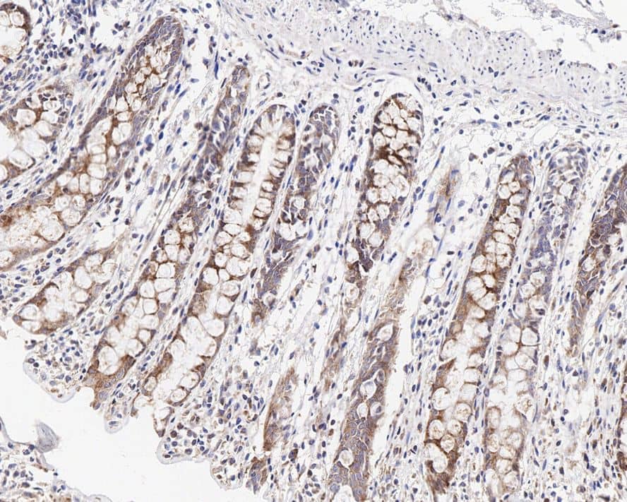 Immunohistochemistry: G3BP1 Antibody (JE35-20) [NBP3-32358] - Immunohistochemical analysis of paraffin-embedded human colon tissue with Rabbit anti-G3BP1 antibody (NBP3-32358) at 1/200 dilution. The section was pre-treated using heat mediated antigen retrieval with Tris-EDTA buffer (pH 9.0) for 20 minutes. The tissues were blocked in 1% BSA for 20 minutes at room temperature, washed with ddH2O and PBS, and then probed with the primary antibody (NBP3-32358) at 1/200 dilution for 1 hour at room temperature. The detection was performed using an HRP conjugated compact polymer system. DAB was used as the chromogen. Tissues were counterstained with hematoxylin and mounted with DPX.