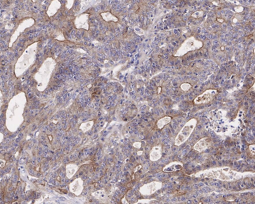 Immunohistochemistry: Granulin Antibody (JE37-73) [NBP3-32371] - Immunohistochemical analysis of paraffin-embedded human colon carcinoma tissue with Rabbit anti-Granulin antibody (NBP3-32371) at 1/1,000 dilution. The section was pre-treated using heat mediated antigen retrieval with Tris-EDTA buffer (pH 9.0) for 20 minutes. The tissues were blocked in 1% BSA for 20 minutes at room temperature, washed with ddH2O and PBS, and then probed with the primary antibody (NBP3-32371) at 1/1,000 dilution for 1 hour at room temperature. The detection was performed using an HRP conjugated compact polymer system. DAB was used as the chromogen. Tissues were counterstained with hematoxylin and mounted with DPX.