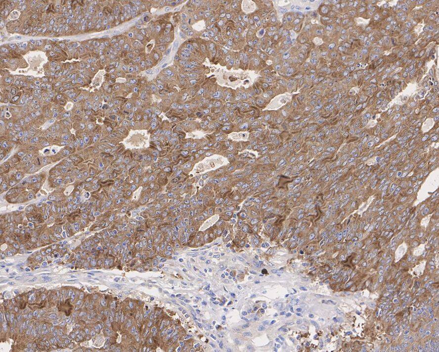 Immunohistochemistry: GFPT1 Antibody (JE43-68) [NBP3-32379] - Immunohistochemical analysis of paraffin-embedded human colon carcinoma tissue with Rabbit anti-GFPT1 antibody (NBP3-32379) at 1/1,000 dilution. The section was pre-treated using heat mediated antigen retrieval with Tris-EDTA buffer (pH 9.0) for 20 minutes. The tissues were blocked in 1% BSA for 20 minutes at room temperature, washed with ddH2O and PBS, and then probed with the primary antibody (NBP3-32379) at 1/1,000 dilution for 1 hour at room temperature. The detection was performed using an HRP conjugated compact polymer system. DAB was used as the chromogen. Tissues were counterstained with hematoxylin and mounted with DPX.