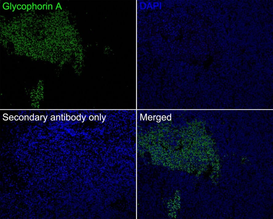 Immunohistochemistry: Glycophorin A Antibody (JE32-24) [NBP3-32393] - Immunofluorescence analysis of paraffin-embedded human hodgkin lymphoma tissue labeling Glycophorin A with Rabbit anti-Glycophorin A antibody (NBP3-32393) at 1/200 dilution. The section was pre-treated using heat mediated antigen retrieval with Tris-EDTA buffer (pH 9.0) for 20 minutes. The tissues were blocked in 10% negative goat serum for 1 hour at room temperature, washed with PBS, and then probed with the primary antibody (NBP3-32393, green) at 1/200 dilution overnight at 4 ℃, washed with PBS. Goat Anti-Rabbit IgG H&L (iFluor™ 488) was used as the secondary antibody at 1/1,000 dilution. Nuclei were counterstained with DAPI (blue).