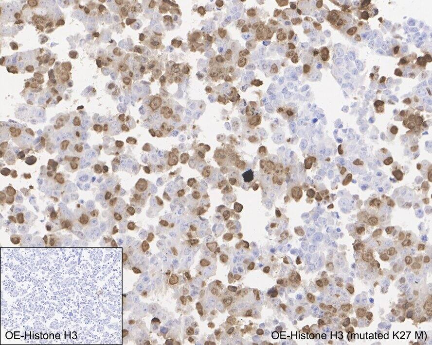 Immunohistochemistry: Histone H3 Antibody (JE46-51) - K27M mutant [NBP3-32401] - Immunohistochemical analysis of paraffin-embedded 293T cells transfacted with Histone H3 / Histone H3 K27M mutant with Rabbit anti-Histone H3 antibody (NBP3-32401) at 1/1,000 dilution. The section was pre-treated using heat mediated antigen retrieval with sodium citrate buffer (pH 6.0) for 2 minutes. The tissues were blocked in 1% BSA for 20 minutes at room temperature, washed with ddH2O and PBS, and then probed with the primary antibody (NBP3-32401) at 1/1,000 dilution for 1 hour at room temperature. The detection was performed using an HRP conjugated compact polymer system. DAB was used as the chromogen. Tissues were counterstained with hematoxylin and mounted with DPX.
