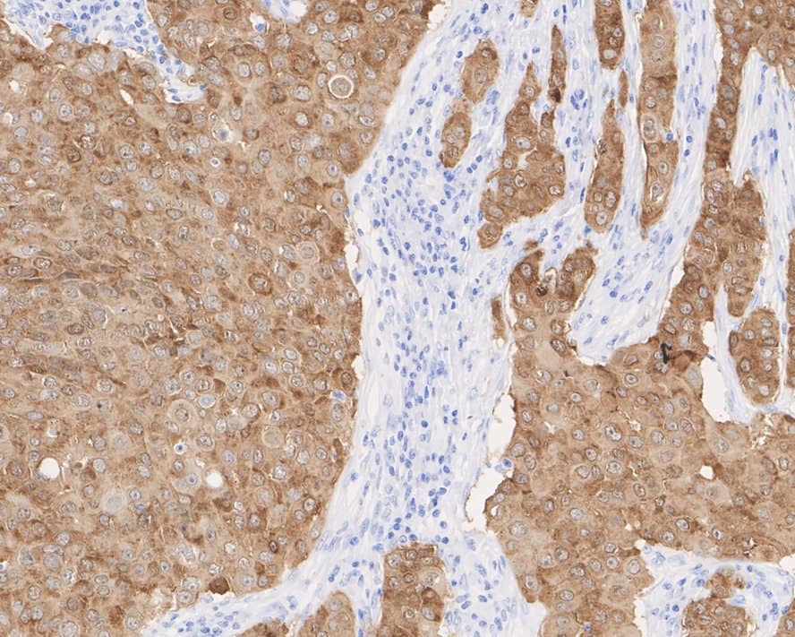 Immunohistochemistry: GRB7 Antibody (JE50-05) [NBP3-32404] - Immunohistochemical analysis of paraffin-embedded human breast cancer tissue with Rabbit anti-GRB7 antibody (NBP3-32404) at 1/2,000 dilution. The section was pre-treated using heat mediated antigen retrieval with Tris-EDTA buffer (pH 9.0) for 20 minutes. The tissues were blocked in 1% BSA for 20 minutes at room temperature, washed with ddH2O and PBS, and then probed with the primary antibody (NBP3-32404) at 1/2,000 dilution for 1 hour at room temperature. The detection was performed using an HRP conjugated compact polymer system. DAB was used as the chromogen. Tissues were counterstained with hematoxylin and mounted with DPX.