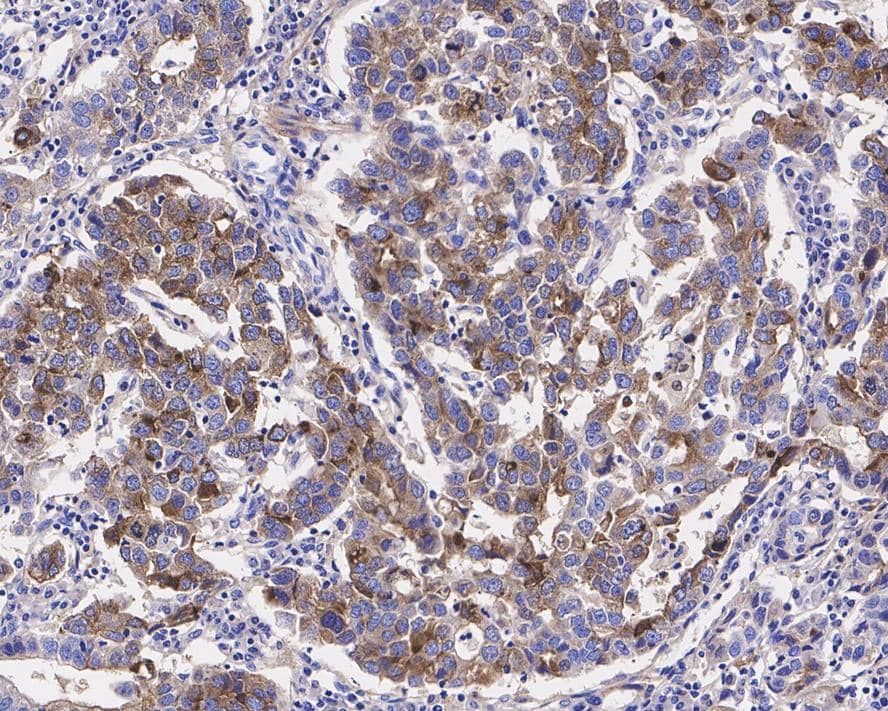 Immunohistochemistry: HRAS Antibody (JE42-15) [NBP3-32413] - Immunohistochemical analysis of paraffin-embedded human stomach carcinoma tissue with Rabbit anti-HRAS antibody (NBP3-32413) at 1/1,000 dilution. The section was pre-treated using heat mediated antigen retrieval with Tris-EDTA buffer (pH 9.0) for 20 minutes. The tissues were blocked in 1% BSA for 20 minutes at room temperature, washed with ddH2O and PBS, and then probed with the primary antibody (NBP3-32413) at 1/1,000 dilution for 1 hour at room temperature. The detection was performed using an HRP conjugated compact polymer system. DAB was used as the chromogen. Tissues were counterstained with hematoxylin and mounted with DPX.