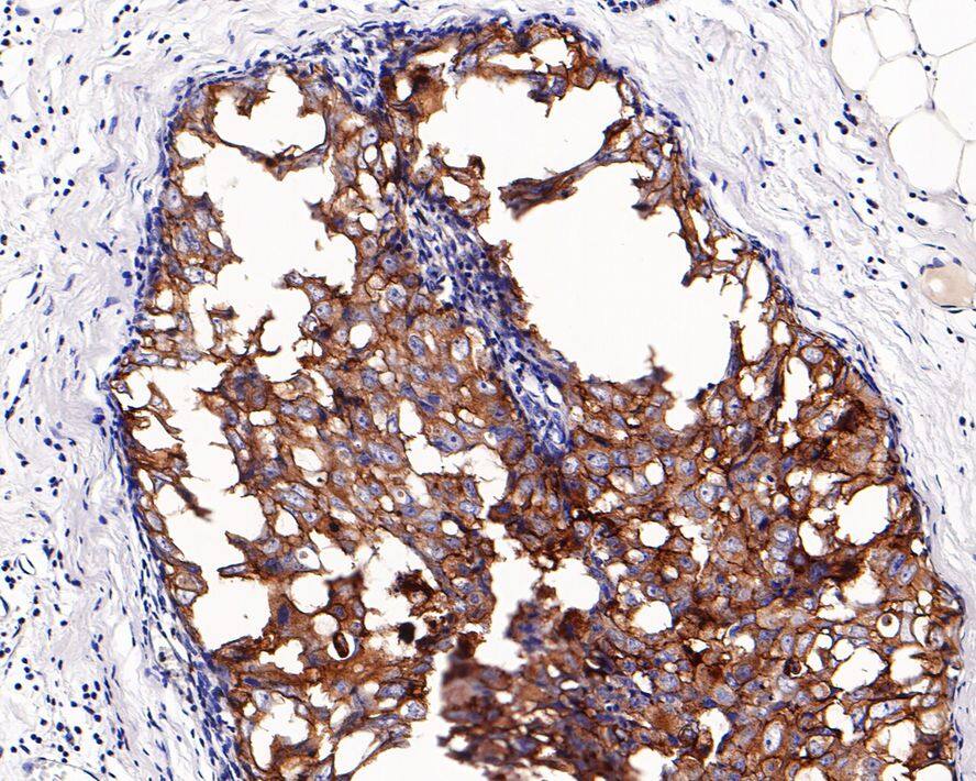 Immunohistochemistry: ErbB2/Her2 Antibody (PD00-53) [NBP3-32422] - Immunohistochemical analysis of paraffin-embedded human breast carcinoma tissue with Rabbit anti-ErbB2/Her2 antibody (NBP3-32422) at 1/2,000 dilution. The section was pre-treated using heat mediated antigen retrieval with Tris-EDTA buffer (pH 9.0) for 20 minutes. The tissues were blocked in 1% BSA for 20 minutes at room temperature, washed with ddH2O and PBS, and then probed with the primary antibody (NBP3-32422) at 1/2,000 dilution for 1 hour at room temperature. The detection was performed using an HRP conjugated compact polymer system. DAB was used as the chromogen. Tissues were counterstained with hematoxylin and mounted with DPX.