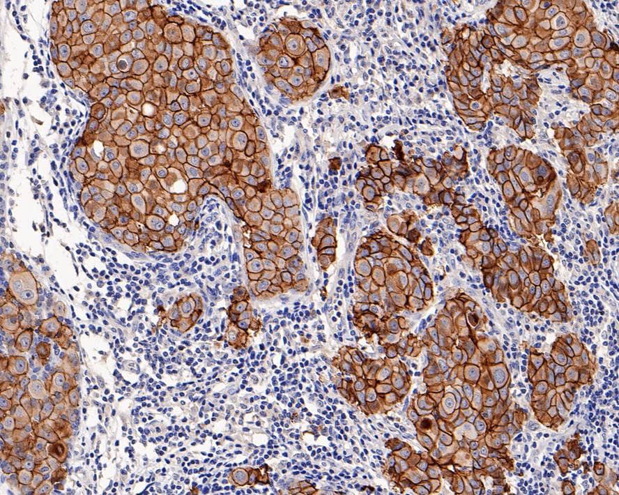 Immunohistochemistry: ErbB2/Her2 Antibody (PD00-99) [NBP3-32423] - Immunohistochemical analysis of paraffin-embedded human breast carcinoma tissue with Rabbit anti-ErbB2/Her2 antibody (NBP3-32423) at 1/4,000 dilution. The section was pre-treated using heat mediated antigen retrieval with Tris-EDTA buffer (pH 9.0) for 20 minutes. The tissues were blocked in 1% BSA for 20 minutes at room temperature, washed with ddH2O and PBS, and then probed with the primary antibody (NBP3-32423) at 1/4,000 dilution for 1 hour at room temperature. The detection was performed using an HRP conjugated compact polymer system. DAB was used as the chromogen. Tissues were counterstained with hematoxylin and mounted with DPX.