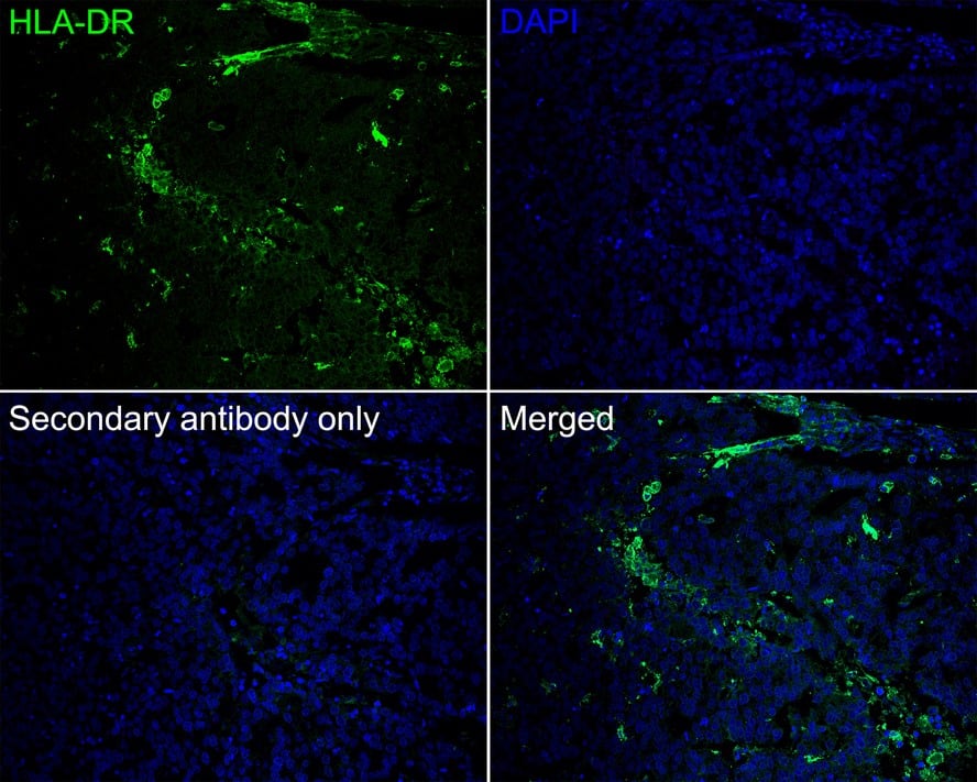 Immunohistochemistry: HLA-DR Antibody (10-D8-R) [NBP3-32435] - Immunofluorescence analysis of paraffin-embedded human stomach cancer tissue labeling HLA-DR with Mouse anti-HLA-DR antibody (NBP3-32435) at 1/100 dilution. The section was pre-treated using heat mediated antigen retrieval with Tris-EDTA buffer (pH 9.0) for 20 minutes. The tissues were blocked in 10% negative goat serum for 1 hour at room temperature, washed with PBS, and then probed with the primary antibody (NBP3-32435, green) at 1/100 dilution overnight at 4 ℃, washed with PBS. Goat Anti-Mouse IgG H&L (iFluor™ 488) was used as the secondary antibody at 1/1,000 dilution. Nuclei were counterstained with DAPI (blue).