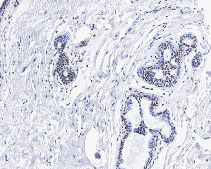 Immunohistochemistry: HMGB2 Antibody (JE52-82) [NBP3-32436] - Immunohistochemical analysis of paraffin-embedded human breast carcinoma tissue with Rabbit anti-HMGB2 antibody (NBP3-32436) at 1/500 dilution. The section was pre-treated using heat mediated antigen retrieval with sodium citrate buffer (pH 6.0) for 2 minutes. The tissues were blocked in 1% BSA for 20 minutes at room temperature, washed with ddH2O and PBS, and then probed with the primary antibody (NBP3-32436) at 1/500 dilution for 1 hour at room temperature. The detection was performed using an HRP conjugated compact polymer system. DAB was used as the chromogen. Tissues were counterstained with hematoxylin and mounted with DPX.