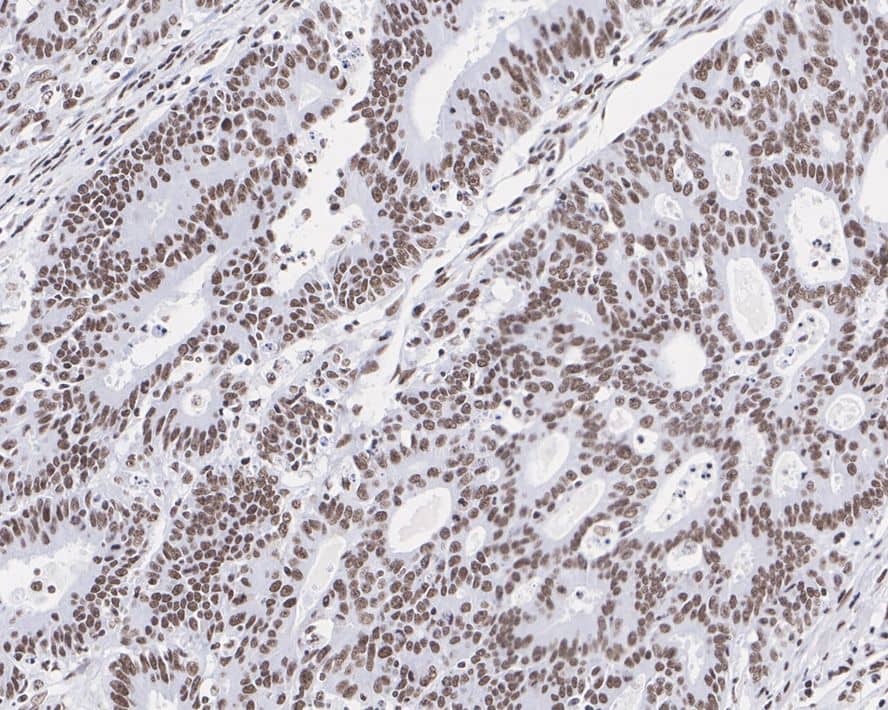 Immunohistochemistry: HSF1 Antibody (JE44-79) [NBP3-32444] - Immunohistochemical analysis of paraffin-embedded human colon carcinoma tissue with Rabbit anti-HSF1 antibody (NBP3-32444) at 1/1,000 dilution. The section was pre-treated using heat mediated antigen retrieval with sodium citrate buffer (pH 6.0) for 2 minutes. The tissues were blocked in 1% BSA for 20 minutes at room temperature, washed with ddH2O and PBS, and then probed with the primary antibody (NBP3-32444) at 1/1,000 dilution for 1 hour at room temperature. The detection was performed using an HRP conjugated compact polymer system. DAB was used as the chromogen. Tissues were counterstained with hematoxylin and mounted with DPX.