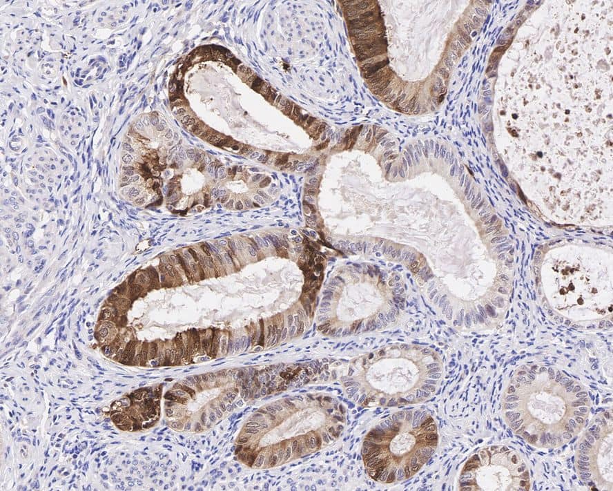 Immunohistochemistry: Indoleamine 2,3-dioxygenase/IDO Antibody (PD00-62) [NBP3-32457] - Immunohistochemical analysis of paraffin-embedded human endometrial carcinoma tissue with Rabbit anti-Indoleamine 2,3-dioxygenase/IDO antibody (NBP3-32457) at 1/200 dilution. The section was pre-treated using heat mediated antigen retrieval with Tris-EDTA buffer (pH 9.0) for 20 minutes. The tissues were blocked in 1% BSA for 20 minutes at room temperature, washed with ddH2O and PBS, and then probed with the primary antibody (NBP3-32457) at 1/200 dilution for 1 hour at room temperature. The detection was performed using an HRP conjugated compact polymer system. DAB was used as the chromogen. Tissues were counterstained with hematoxylin and mounted with DPX.