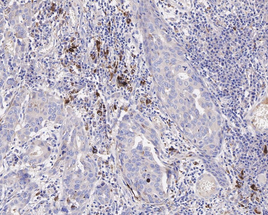 Immunohistochemistry: iNOS Antibody (PSH03-69) [NBP3-32473] - Immunohistochemical analysis of paraffin-embedded human breast carcinoma tissue with Rabbit anti-iNOS antibody (NBP3-32473) at 1/200 dilution. The section was pre-treated using heat mediated antigen retrieval with Tris-EDTA buffer (pH 9.0) for 20 minutes. The tissues were blocked in 1% BSA for 20 minutes at room temperature, washed with ddH2O and PBS, and then probed with the primary antibody (NBP3-32473) at 1/200 dilution for 1 hour at room temperature. The detection was performed using an HRP conjugated compact polymer system. DAB was used as the chromogen. Tissues were counterstained with hematoxylin and mounted with DPX.