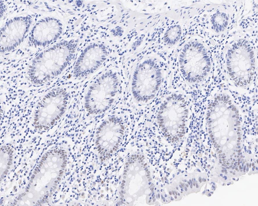 Immunohistochemistry: Lysine (K)-specific Demethylase 4A/KDM4A/JMJD2A Antibody (PSH03-67) [NBP3-32493] - Immunohistochemical analysis of paraffin-embedded human colon tissue with Rabbit anti-Lysine (K)-specific Demethylase 4A/KDM4A/JMJD2A antibody (NBP3-32493) at 1/1,000 dilution. The section was pre-treated using heat mediated antigen retrieval with sodium citrate buffer (pH 6.0) for 2 minutes. The tissues were blocked in 1% BSA for 20 minutes at room temperature, washed with ddH2O and PBS, and then probed with the primary antibody (NBP3-32493) at 1/1,000 dilution for 1 hour at room temperature. The detection was performed using an HRP conjugated compact polymer system. DAB was used as the chromogen. Tissues were counterstained with hematoxylin and mounted with DPX.