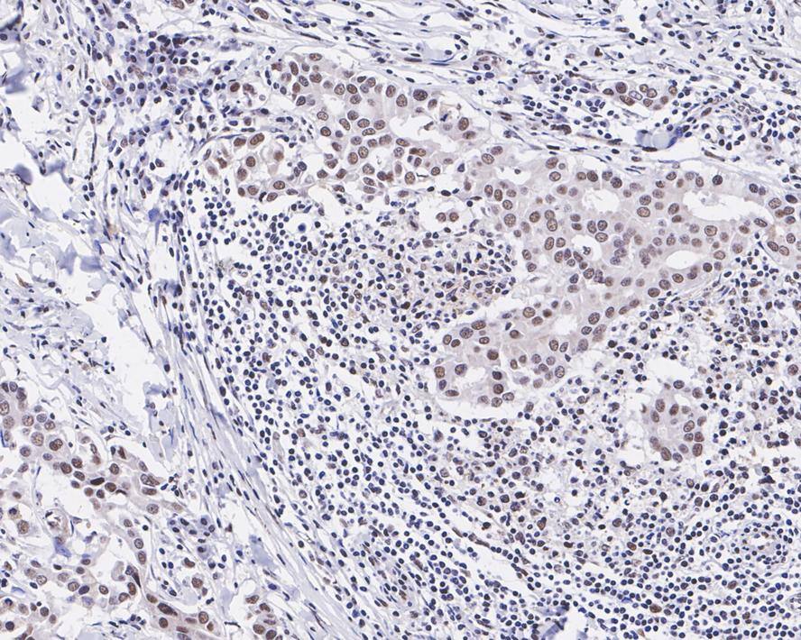 Immunohistochemistry: JMJD2B Antibody (JE36-58) [NBP3-32494] - Immunohistochemical analysis of paraffin-embedded human breast carcinoma tissue with Rabbit anti-JMJD2B antibody (NBP3-32494) at 1/200 dilution. The section was pre-treated using heat mediated antigen retrieval with sodium citrate buffer (pH 6.0) for 2 minutes. The tissues were blocked in 1% BSA for 20 minutes at room temperature, washed with ddH2O and PBS, and then probed with the primary antibody (NBP3-32494) at 1/200 dilution for 1 hour at room temperature. The detection was performed using an HRP conjugated compact polymer system. DAB was used as the chromogen. Tissues were counterstained with hematoxylin and mounted with DPX.