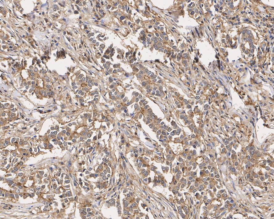 Immunohistochemical analysis of paraffin-embedded human breast cancer tissue with Immunohistochemistry: BLTP2 Antibody (A0-F3-R) at 1/2,000 dilution. The section was pre-treated using heat mediated antigen retrieval with Tris-EDTA buffer (pH 9.0) for 20 minutes. The tissues were blocked in 1% BSA for 20 minutes at room temperature, washed with ddH2O and PBS, and then probed with the primary antibody at 1/2,000 dilution for 1 hour at room temperature. The detection was performed using an HRP conjugated compact polymer system. DAB was used as the chromogen. Tissues were counterstained with hematoxylin and mounted with DPX.