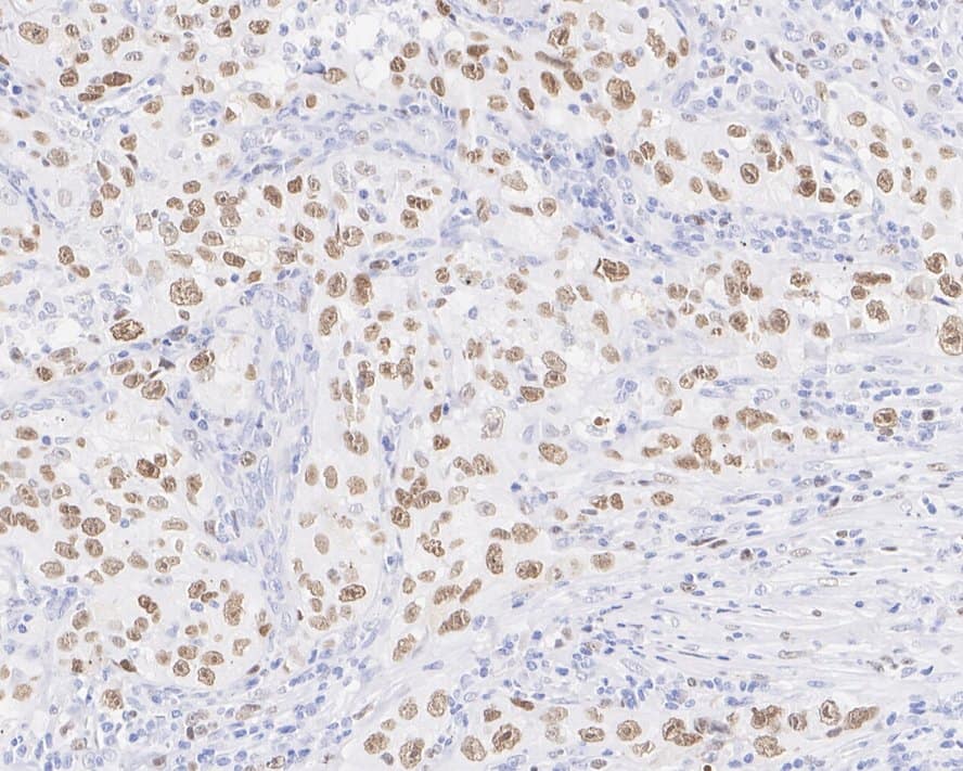 Immunohistochemistry: Kif4A Antibody (JE38-91) [NBP3-32502] - Immunohistochemical analysis of paraffin-embedded human lung carcinoma tissue with Rabbit anti-Kif4A antibody (NBP3-32502) at 1/1,000 dilution. The section was pre-treated using heat mediated antigen retrieval with Tris-EDTA buffer (pH 9.0) for 20 minutes. The tissues were blocked in 1% BSA for 20 minutes at room temperature, washed with ddH2O and PBS, and then probed with the primary antibody (NBP3-32502) at 1/1,000 dilution for 1 hour at room temperature. The detection was performed using an HRP conjugated compact polymer system. DAB was used as the chromogen. Tissues were counterstained with hematoxylin and mounted with DPX.