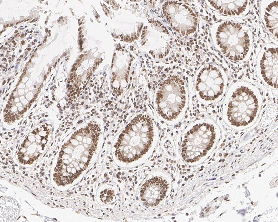 Immunohistochemistry: Importin beta/KPNB1 Antibody (PSH01-60) [NBP3-32511] - Immunohistochemical analysis of paraffin-embedded human colon tissue with Rabbit anti-Importin beta/KPNB1 antibody (NBP3-32511) at 1/1,000 dilution. The section was pre-treated using heat mediated antigen retrieval with sodium citrate buffer (pH 6.0) for 2 minutes. The tissues were blocked in 1% BSA for 20 minutes at room temperature, washed with ddH2O and PBS, and then probed with the primary antibody (NBP3-32511) at 1/1,000 dilution for 1 hour at room temperature. The detection was performed using an HRP conjugated compact polymer system. DAB was used as the chromogen. Tissues were counterstained with hematoxylin and mounted with DPX.