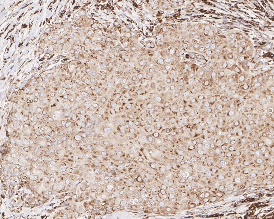 Immunohistochemistry: Metadherin Antibody (C6-C10-R) [NBP3-32551] - Immunohistochemical analysis of paraffin-embedded human breast carcinoma tissue with Mouse anti-Metadherin antibody (NBP3-32551) at 1/1,000 dilution. The section was pre-treated using heat mediated antigen retrieval with sodium citrate buffer (pH 6.0) for 2 minutes. The tissues were blocked in 1% BSA for 20 minutes at room temperature, washed with ddH2O and PBS, and then probed with the primary antibody (NBP3-32551) at 1/1,000 dilution for 1 hour at room temperature. The detection was performed using an HRP conjugated compact polymer system. DAB was used as the chromogen. Tissues were counterstained with hematoxylin and mounted with DPX.