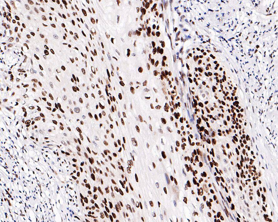 Immunohistochemistry: MCM2 Antibody (PD00-90) [NBP3-32576] - Immunohistochemical analysis of paraffin-embedded human cervical carcinoma tissue with Rabbit anti-MCM2 antibody (NBP3-32576) at 1/800 dilution. The section was pre-treated using heat mediated antigen retrieval with Tris-EDTA buffer (pH 9.0) for 20 minutes. The tissues were blocked in 1% BSA for 20 minutes at room temperature, washed with ddH2O and PBS, and then probed with the primary antibody (NBP3-32576) at 1/800 dilution for 1 hour at room temperature. The detection was performed using an HRP conjugated compact polymer system. DAB was used as the chromogen. Tissues were counterstained with hematoxylin and mounted with DPX.
