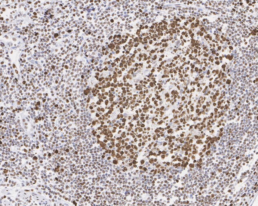 Immunohistochemistry: MCM2 Antibody (JE42-39) [NBP3-32577] - Immunohistochemical analysis of paraffin-embedded human lymph nodes tissue with Rabbit anti-MCM2 antibody (NBP3-32577) at 1/1,000 dilution. The section was pre-treated using heat mediated antigen retrieval with sodium citrate buffer (pH 6.0) for 2 minutes. The tissues were blocked in 1% BSA for 20 minutes at room temperature, washed with ddH2O and PBS, and then probed with the primary antibody (NBP3-32577) at 1/1,000 dilution for 1 hour at room temperature. The detection was performed using an HRP conjugated compact polymer system. DAB was used as the chromogen. Tissues were counterstained with hematoxylin and mounted with DPX.