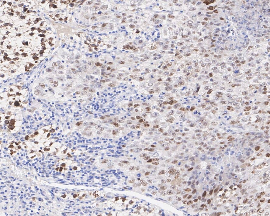 Immunohistochemistry: MDM2/HDM2 Antibody (A10E11-R) [NBP3-32584] - Immunohistochemical analysis of paraffin-embedded human embryonal carcinoma tissue with Mouse anti-MDM2/HDM2 antibody (NBP3-32584) at 1/1,000 dilution. The section was pre-treated using heat mediated antigen retrieval with sodium citrate buffer (pH 6.0) for 2 minutes. The tissues were blocked in 1% BSA for 20 minutes at room temperature, washed with ddH2O and PBS, and then probed with the primary antibody (NBP3-32584) at 1/1,000 dilution for 1 hour at room temperature. The detection was performed using an HRP conjugated compact polymer system. DAB was used as the chromogen. Tissues were counterstained with hematoxylin and mounted with DPX.