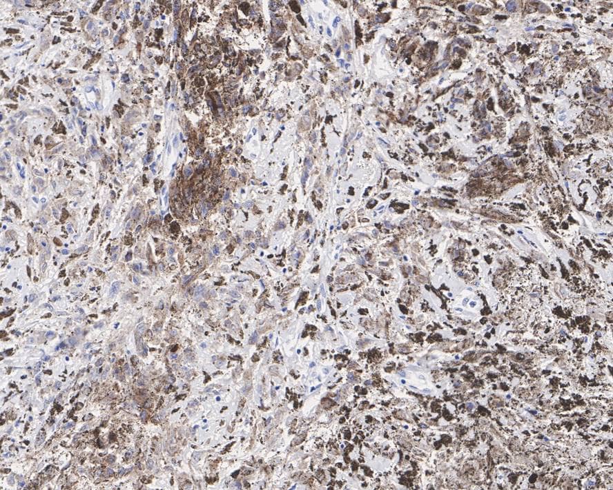 Immunohistochemistry: PMEL17/SILV Antibody (JE42-47) [NBP3-32586] - Immunohistochemical analysis of paraffin-embedded human melanoma tissue with Rabbit anti-PMEL17/SILV antibody (NBP3-32586) at 1/1,000 dilution. The section was pre-treated using heat mediated antigen retrieval with Tris-EDTA buffer (pH 9.0) for 20 minutes. The tissues were blocked in 1% BSA for 20 minutes at room temperature, washed with ddH2O and PBS, and then probed with the primary antibody (NBP3-32586) at 1/1,000 dilution for 1 hour at room temperature. The detection was performed using an HRP conjugated compact polymer system. DAB was used as the chromogen. Tissues were counterstained with hematoxylin and mounted with DPX.