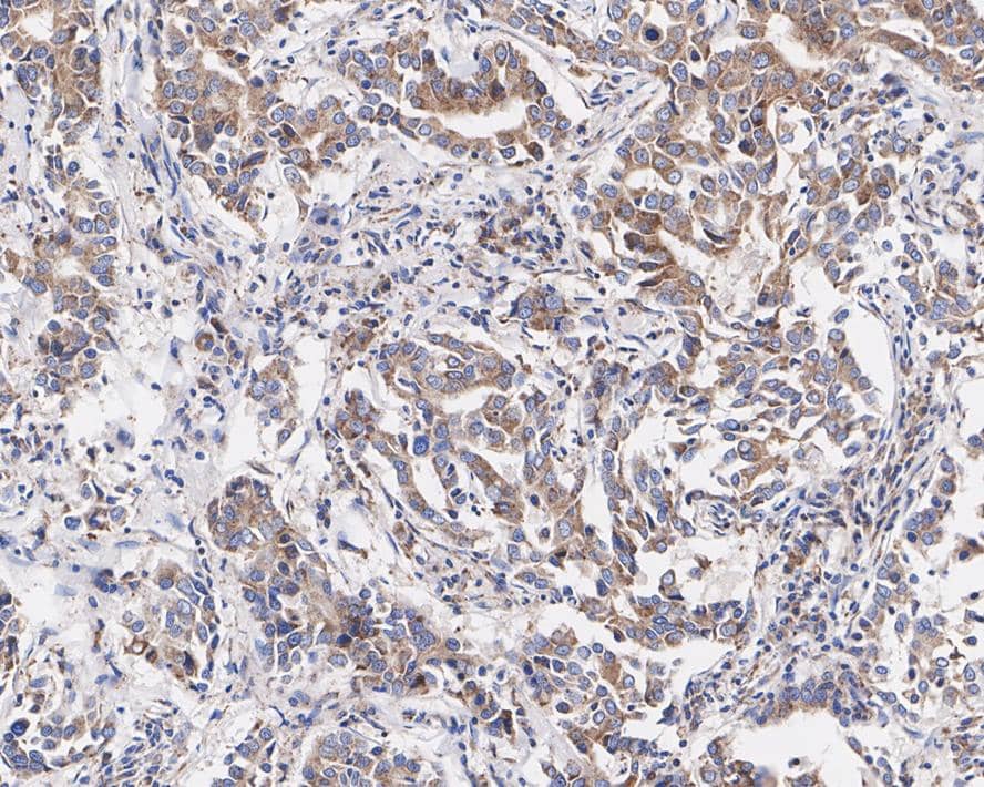 Immunohistochemistry: MELK Antibody (PSH03-55) [NBP3-32587] - Immunohistochemical analysis of paraffin-embedded human breast cancer tissue with Rabbit anti-MELK antibody (NBP3-32587) at 1/500 dilution. The section was pre-treated using heat mediated antigen retrieval with Tris-EDTA buffer (pH 9.0) for 20 minutes. The tissues were blocked in 1% BSA for 20 minutes at room temperature, washed with ddH2O and PBS, and then probed with the primary antibody (NBP3-32587) at 1/500 dilution for 1 hour at room temperature. The detection was performed using an HRP conjugated compact polymer system. DAB was used as the chromogen. Tissues were counterstained with hematoxylin and mounted with DPX.